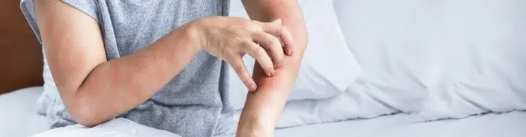 alergia-acaros